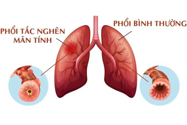 Tìm hiểu về bệnh tắc nghẽn phổi mãn tính và cách phòng ngừa