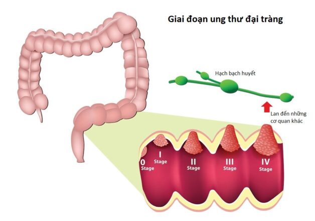 Tìm hiểu về bệnh ung thư đại tràng giai đoạn đầu