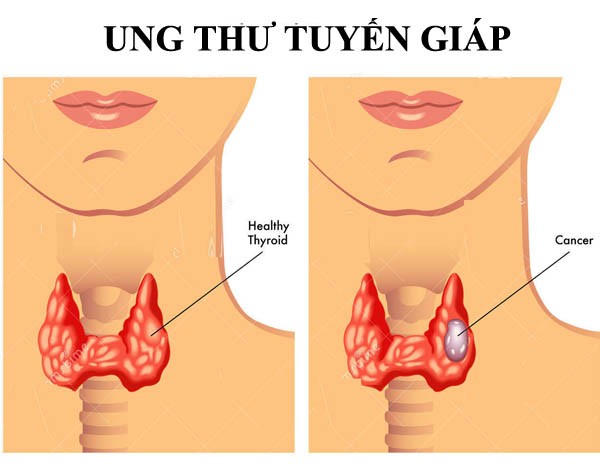 Tìm hiểu về bệnh ung thư tuyến giáp