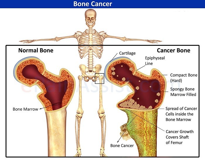 Tìm hiểu về bệnh ung thư xương