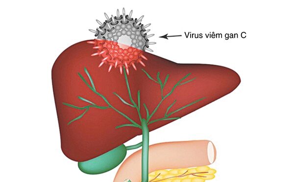 Tìm hiểu về bệnh viêm gan C