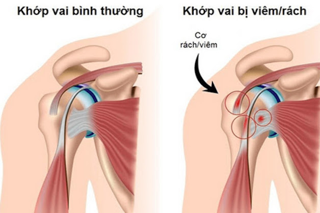 Tìm hiểu về bệnh viêm khớp vai và cách điều trị