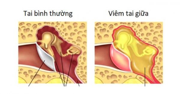 Tìm hiểu về bệnh viêm tai xương chũm mạn tính