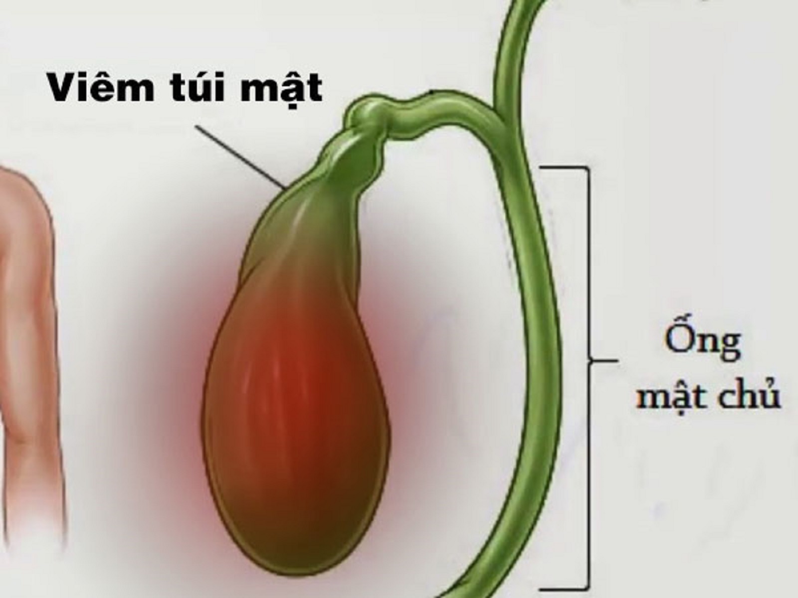 Tìm hiểu về bệnh viêm túi mật cấp và cách điều trị hiệu quả