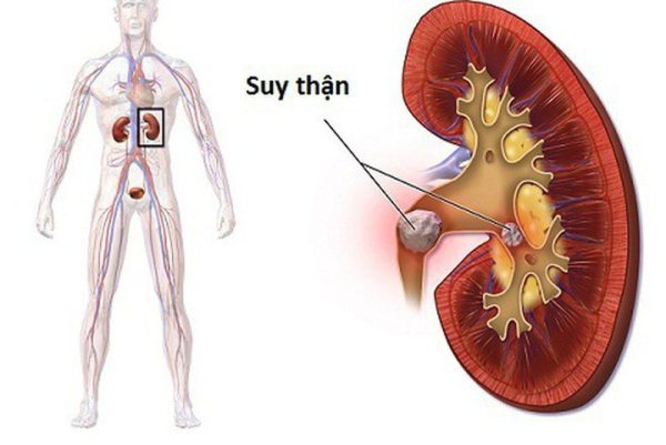 Tìm hiểu về các phương pháp điều trị sỏi niệu quản