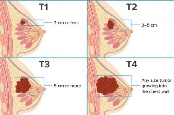 Tìm hiểu về các phương pháp trị ung thư vú