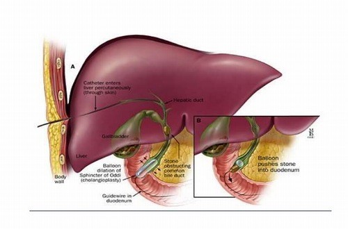 Tìm hiểu về các triệu chứng bệnh sỏi gan