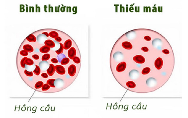 Tìm hiểu về căn bệnh thiếu máu não ở trẻ em