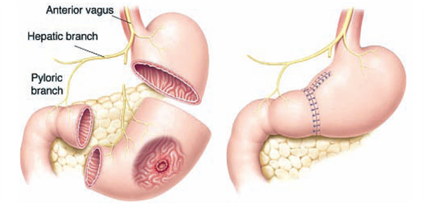 Tìm hiểu về chỉ định phẫu thuật ung thư dạ dày