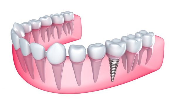 Tìm hiểu về chi phí trồng răng hàm tại nha khoa hiện nay