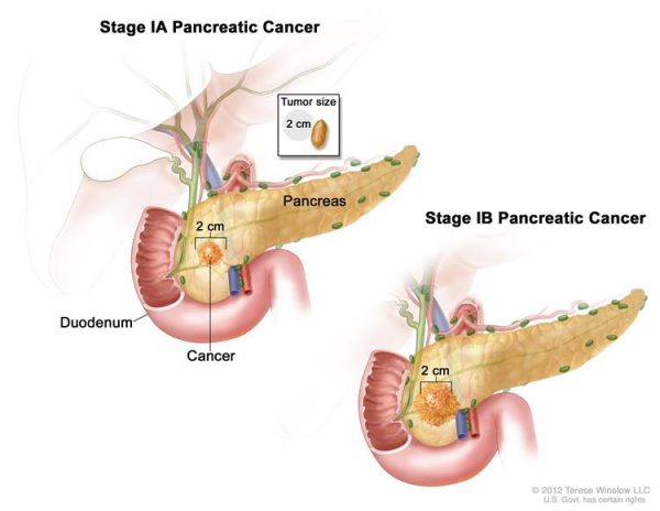 Tìm hiểu về dấu hiệu ung thư tuyến tụy giai đoạn đầu