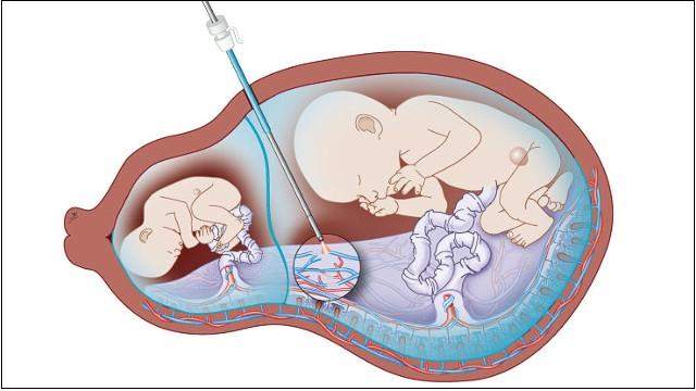 Tìm hiểu về hội chứng truyền máu song thai