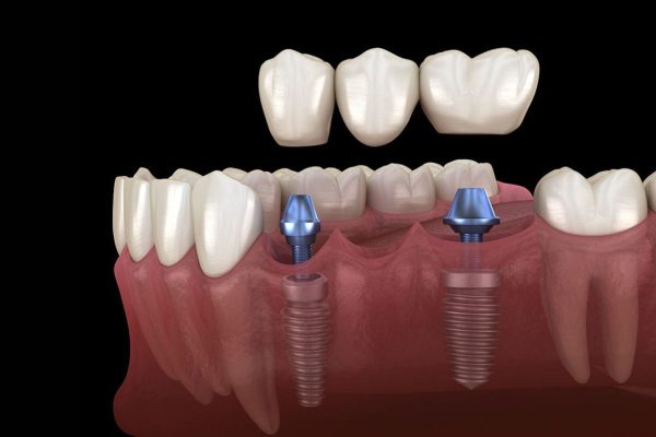 Tìm hiểu về kỹ thuật phục hình răng sứ trên Implant