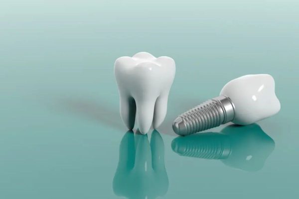 Tìm hiểu về kỹ thuật phục hình răng sứ trên Implant