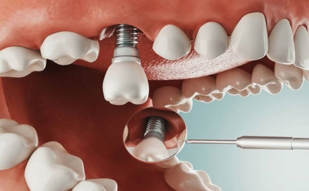 Tìm hiểu về kỹ thuật trồng răng Implant và địa chỉ thực hiện uy tín