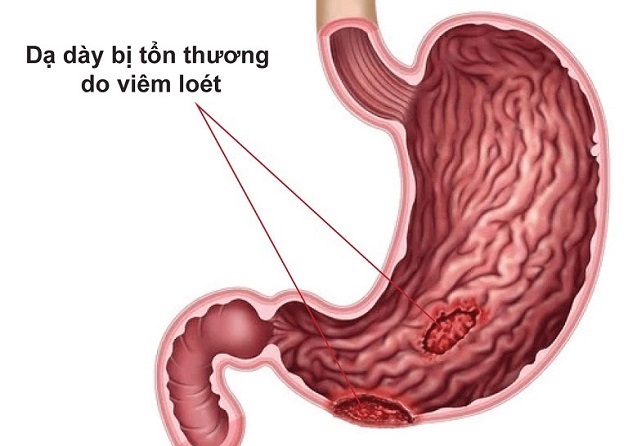 Tìm hiểu về  loét dạ dày mãn tính