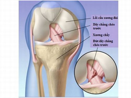 Tìm hiểu về mổ đứt dây chằng đầu gối