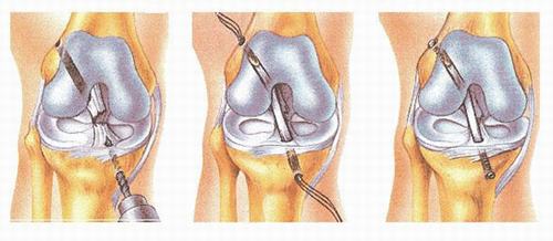 Tìm hiểu về mổ đứt dây chằng đầu gối