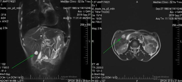 Tìm hiểu về MRI tuyến thượng thận