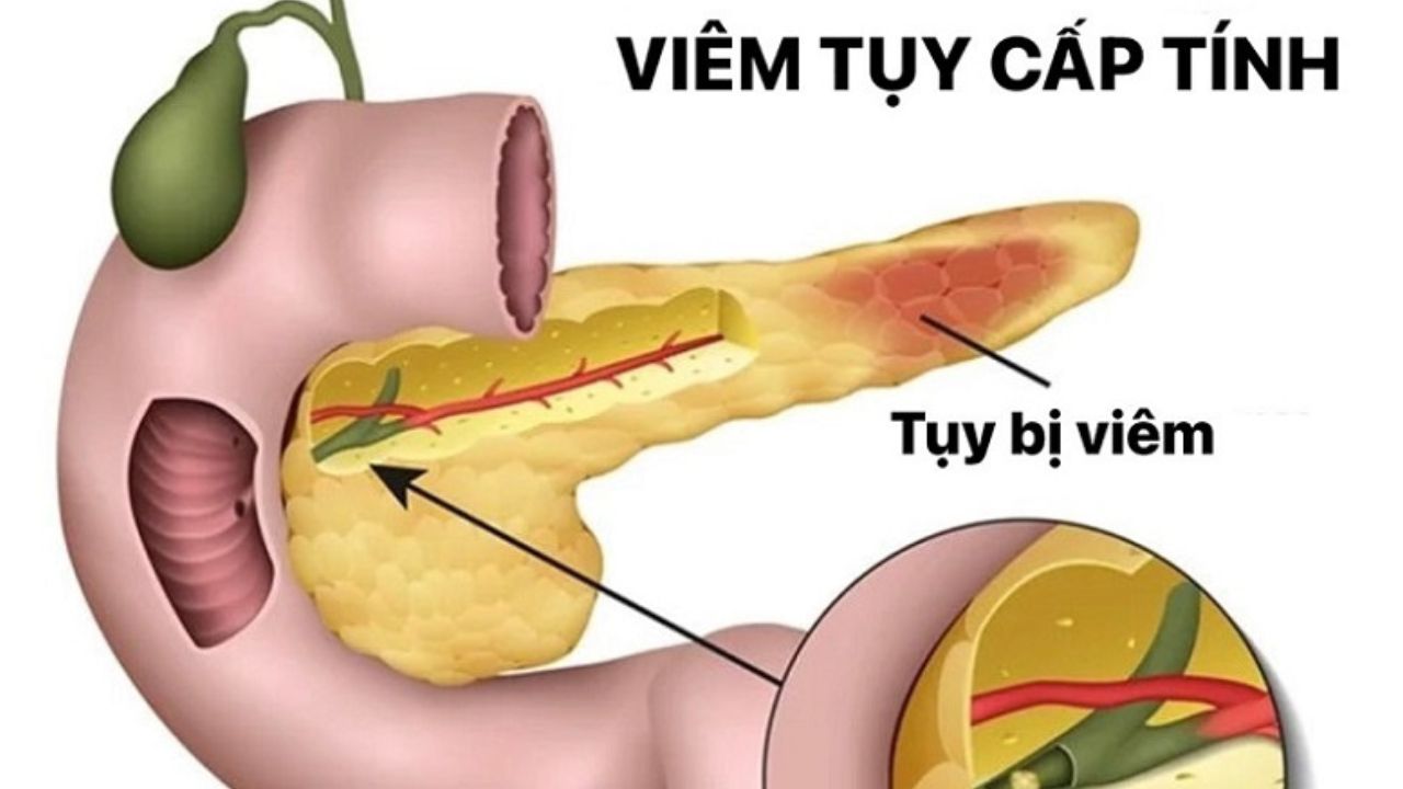 Tìm hiểu về mức độ nguy hiểm của bệnh viêm tụy cấp