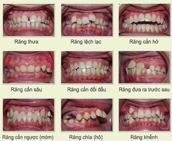 Tìm hiểu về nắn chỉnh răng – Bí quyết sở hữu răng