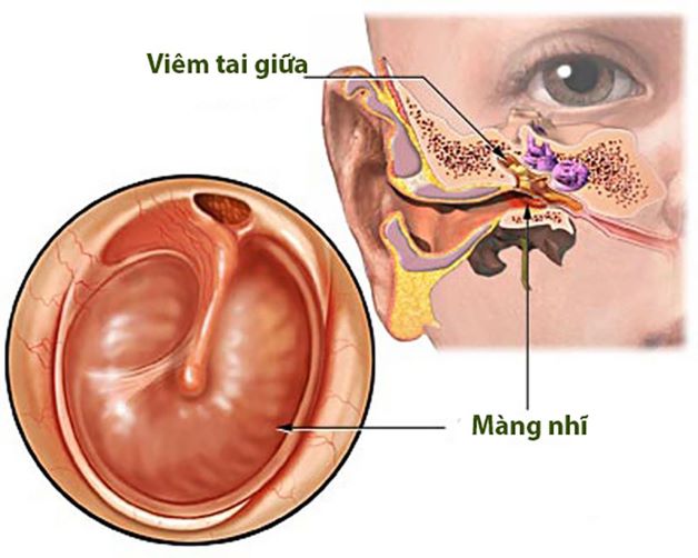 Tìm hiểu về nguyên nhân, triệu chứng bệnh viêm tai giữa ở trẻ nhỏ?