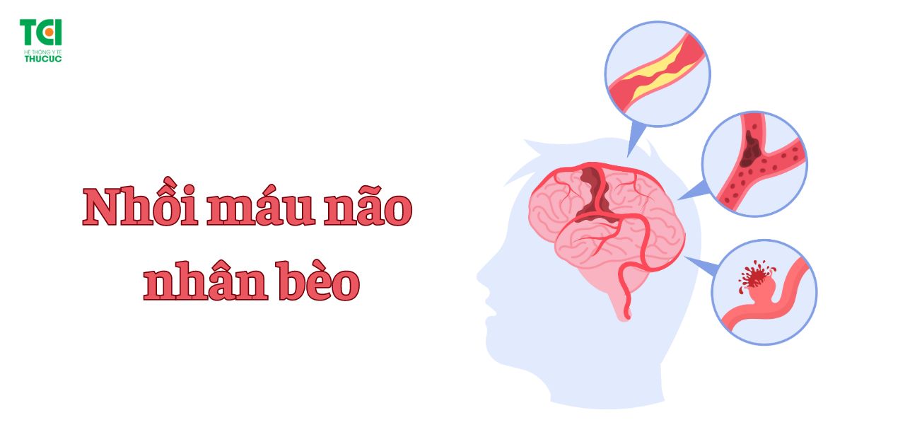 Tìm hiểu về nhồi máu não nhân bèo