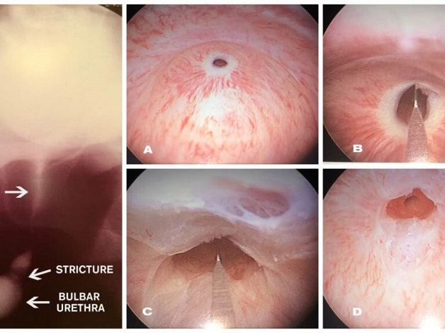 Tìm hiểu về nội soi tán sỏi ngược dòng