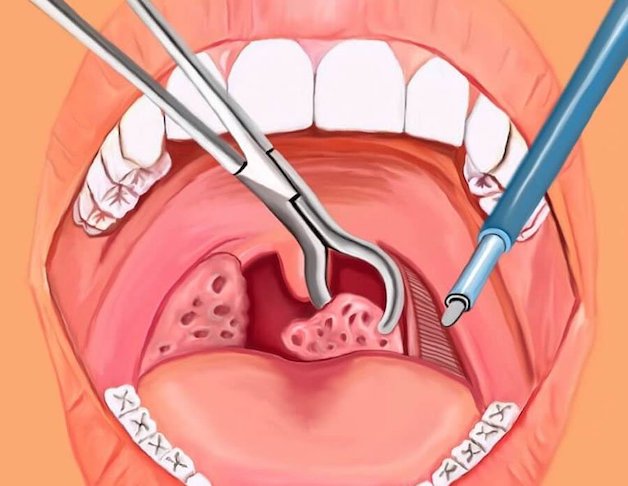 Tìm hiểu về phương pháp cắt amidan bằng laser