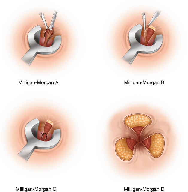 Tìm hiểu về phương pháp cắt trĩ Milligan Morgan