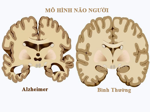 Tìm hiểu về phương pháp chẩn đoán hình ảnh Alzheimer