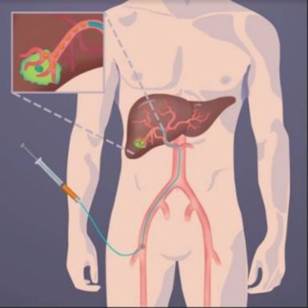 Tìm hiểu về phương pháp nút mạch điều trị ung thư gan