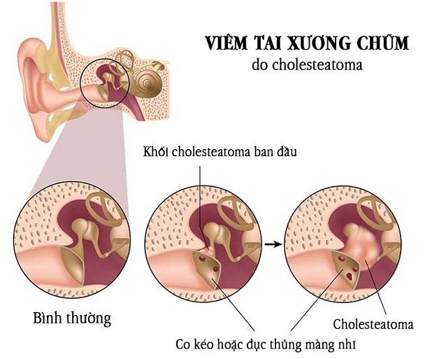 Tìm hiểu về phương pháp phẫu thuật viêm tai xương chũm