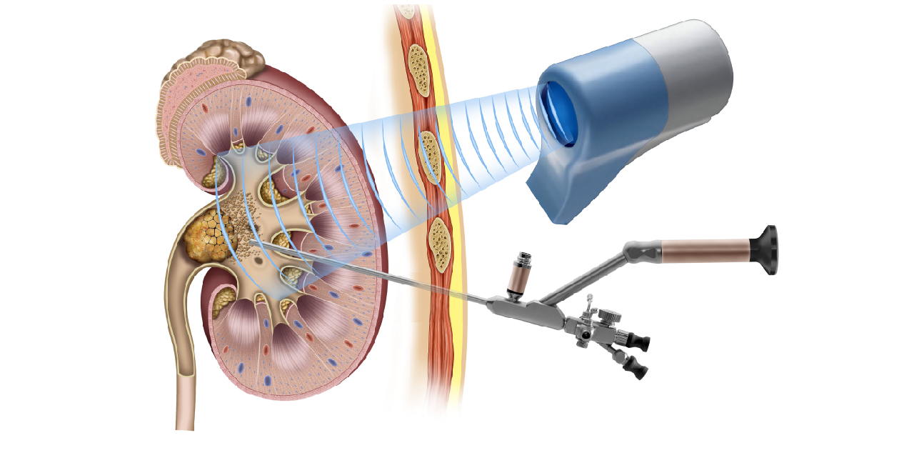 Tìm hiểu về phương pháp tán sỏi thận bằng laser