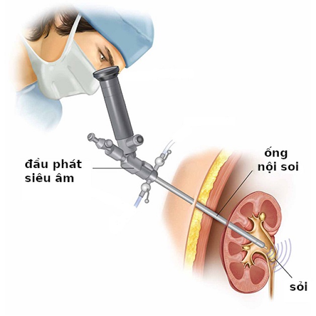 Tìm hiểu về phương pháp tán sỏi thận bằng laser