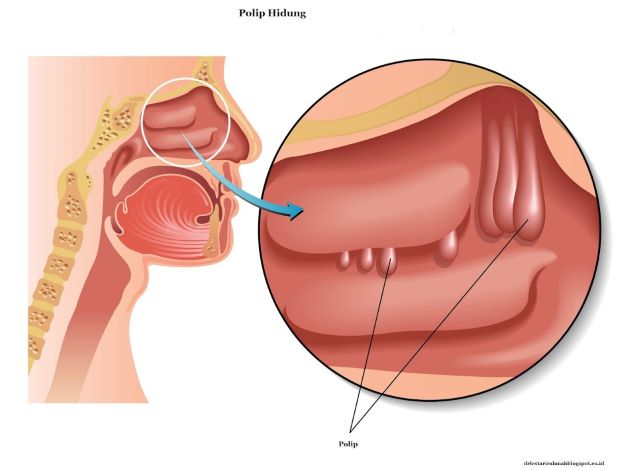 Tìm hiểu về Polyp xoang hàm