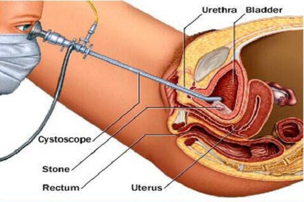 Tìm hiểu về quy trình tán sỏi bàng quang