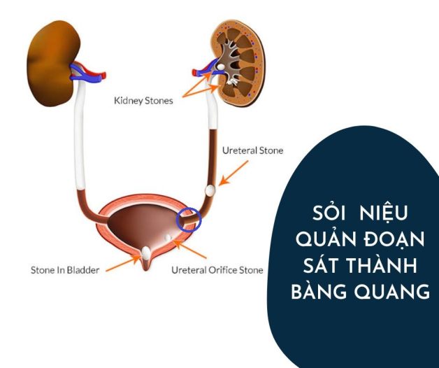 Tìm hiểu về sỏi niệu quản đoạn nội thành bàng quang