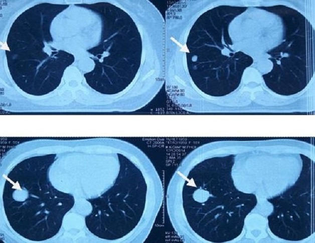 Tìm hiểu về tầm soát ung thư phổi bằng CT liều thấp