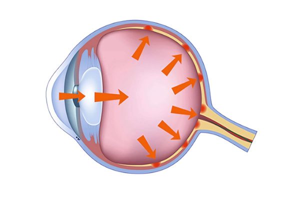 Tìm hiểu về tăng nhãn áp và triệu chứng nhận biết