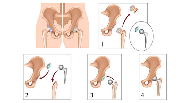 Tìm hiểu về thay khớp háng toàn phần và bán phần