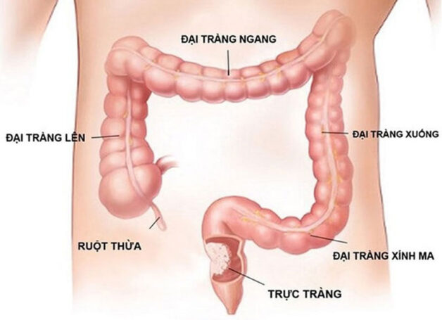 Tìm hiểu về tiên lượng sống của bệnh ung thư đại tràng