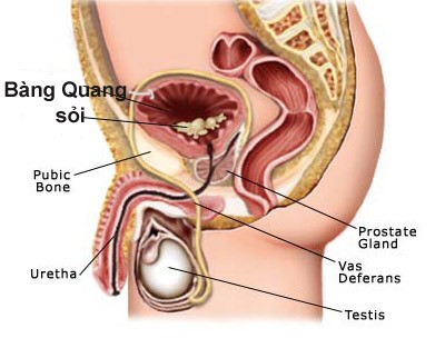 Tìm hiểu về tình trạng sỏi thận rơi xuống bàng quang