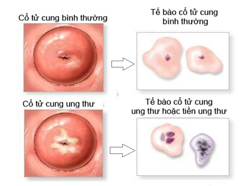 Tìm hiểu về tổn thương tiền ung thư cổ tử cung