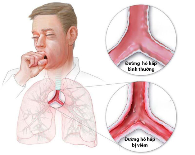 Tìm hiểu về trào ngược dạ dày thực quản icd 10