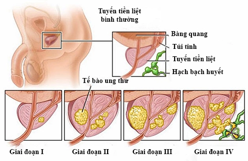 Tìm hiểu về triệu chứng ung thư tuyến tiền liệt giai đoạn đầu