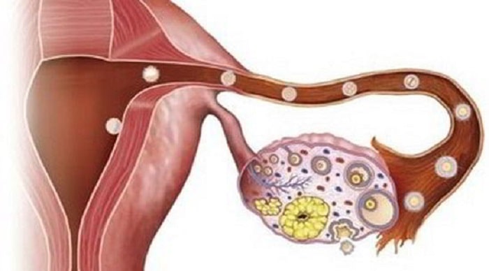 Tìm hiểu về u nang bì buồng trứng phải