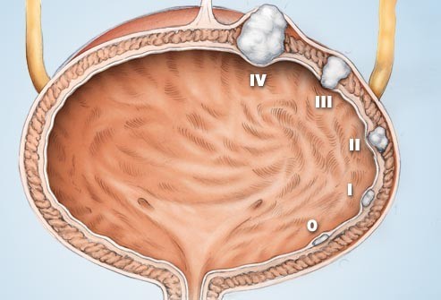 Tìm hiểu về ung thư bàng quang qua các hình ảnh