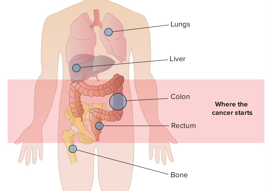 Tìm hiểu về ung thư đại tràng giai đoạn cuối