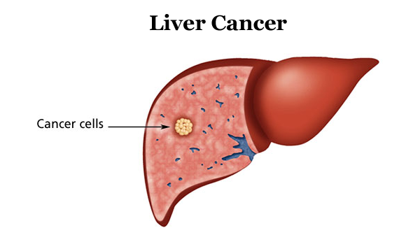 Tìm hiểu về ung thư gan tái phát